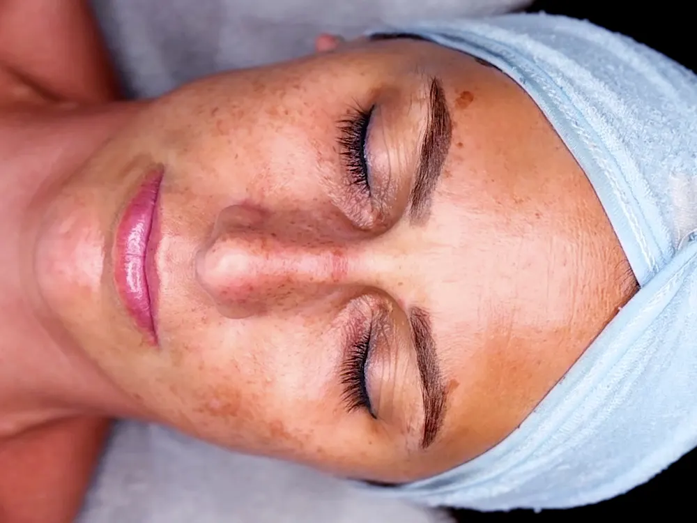 Carbon peeling kezelés után, üde, sima és megújult arcbőr eredménye