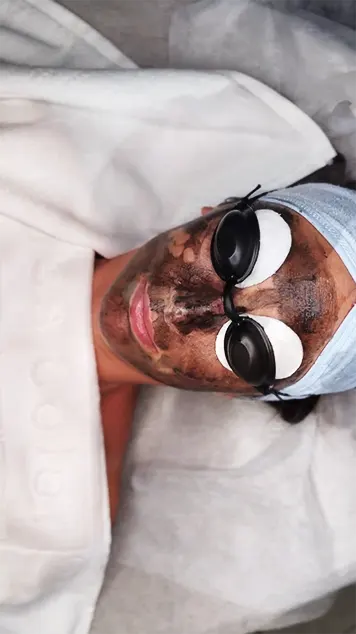 Carbon peeling kezelés közben Budapesten, speciális szénmaszk és védőszemüveg használatával a bőr mélytisztításáért