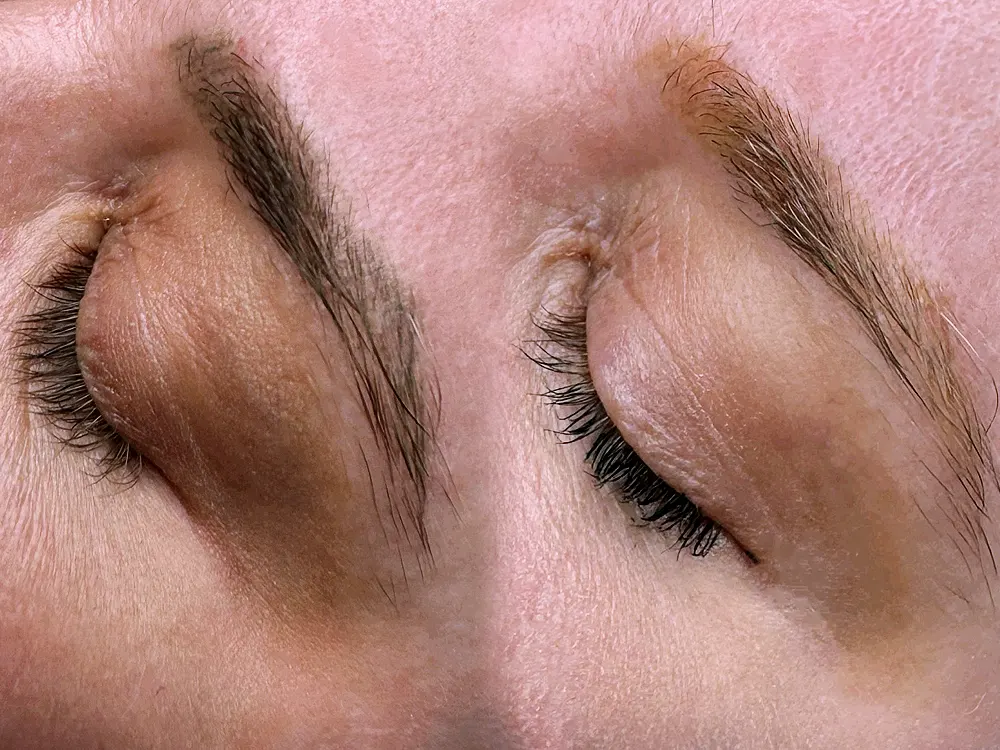 Carbon peeling kezelés sminktetoválás halványítására, szemöldök tetoválás előtte-utána eredmény