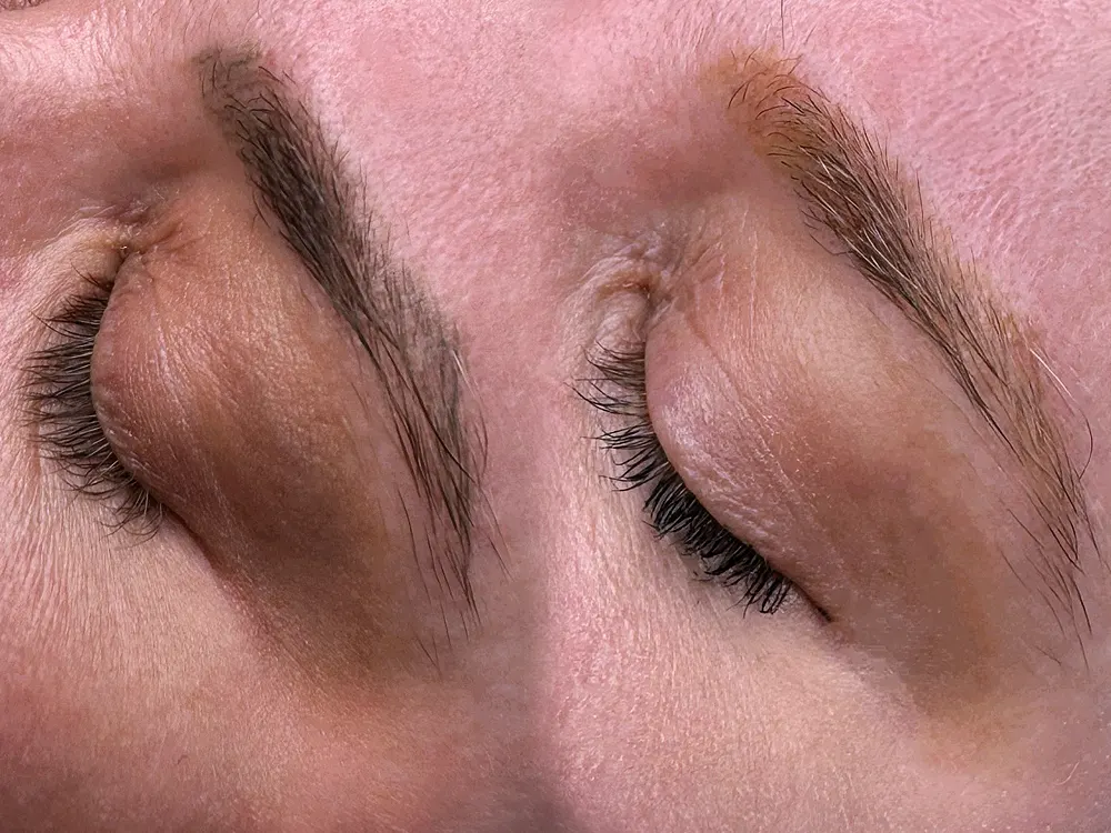 Lézeres tetoválás eltávolítás Budapesten Orosz Grétánál, professzionális lézeres gép és steril környezet a kezeléshez