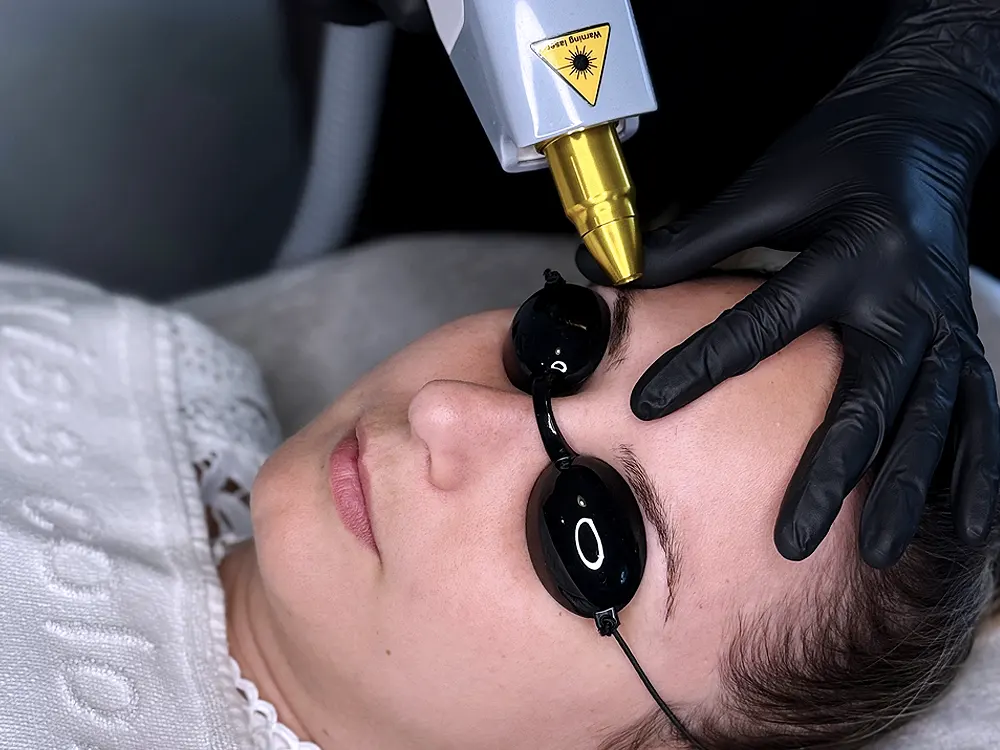 Lézeres szemöldök tetoválás eltávolítás közben, Orosz Gréta kozmetikus kezelése Budapesten