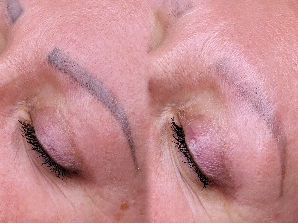 Elrontott szemöldök tetoválás eltávolítás előtte-utána képek, lézeres korrekció Zuglóban