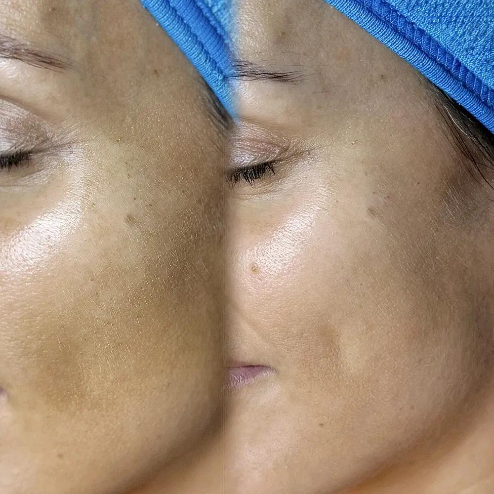 Carbon peeling arckezelés hatása közelről, pórusok és bőrtextúra javulása előtte utána